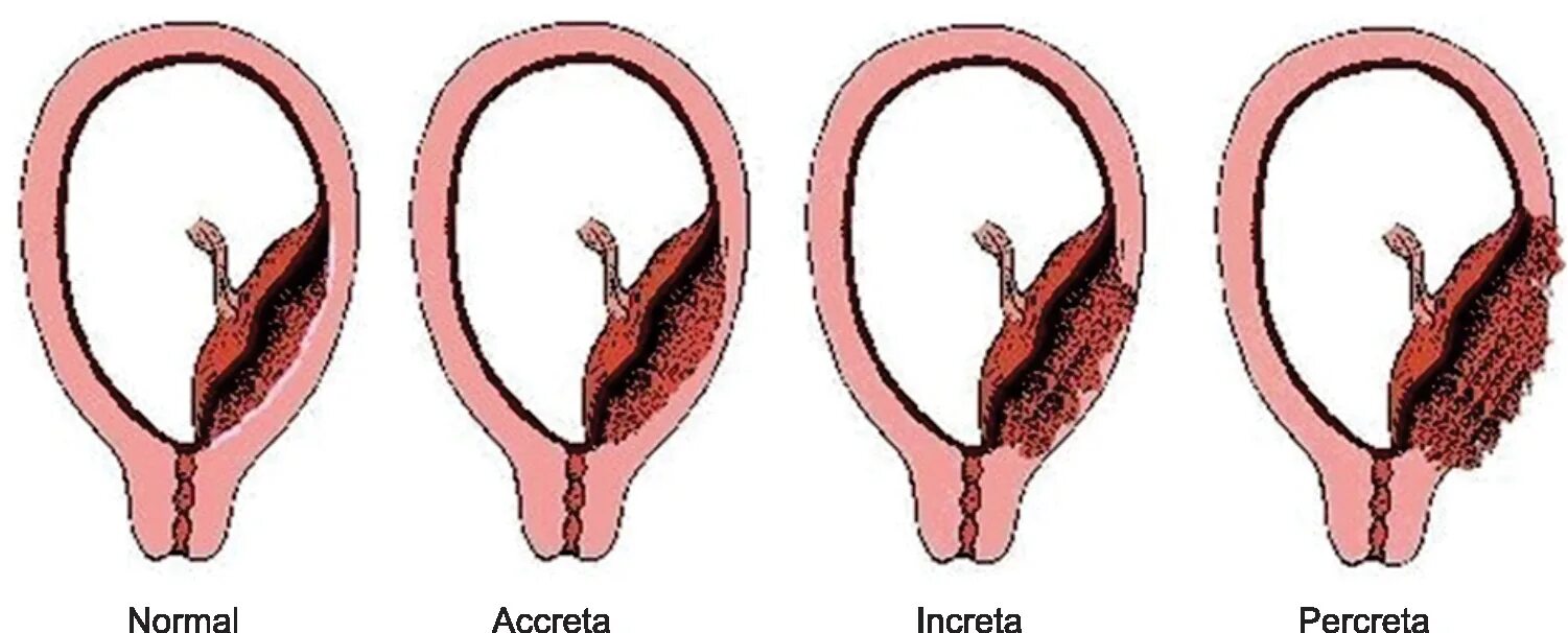 Истинное приращение. Прикрепление и врастание плаценты. Патология прикрепления плаценты. Степени приращения плаценты. Врастание плаценты классификация.