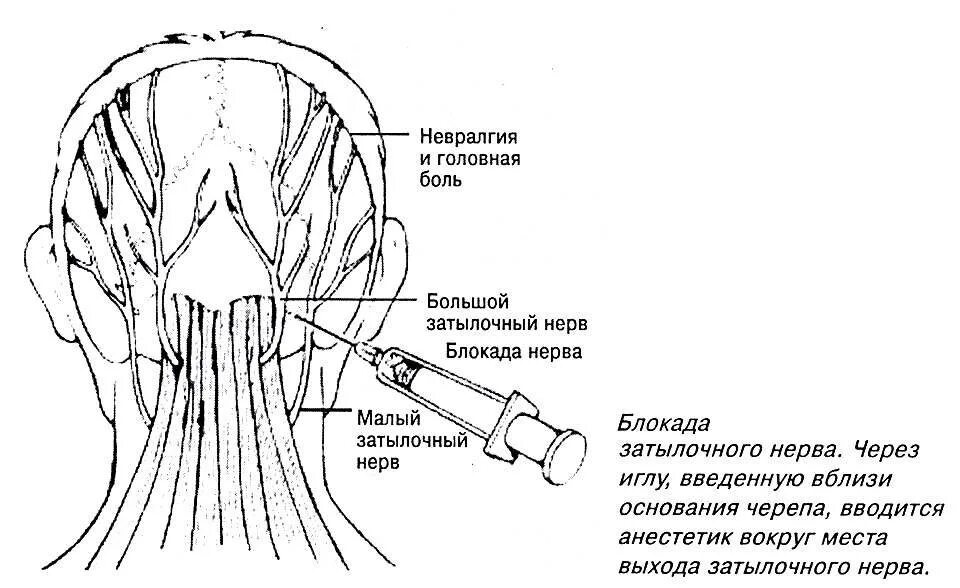 Методика блокады большого затылочного нерва. Невропатология затылочного нерва. Затылочный нерв анатомия схема.