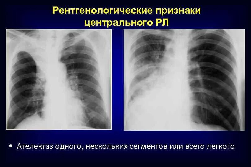 Тотальный ателектаз справа рентген. Рентгенологические признаки ателектаза. Основные рентгенологические симптомы. Обтурационный ателектаз легкого рентген. Ателектаз верхней доли левого легкого.