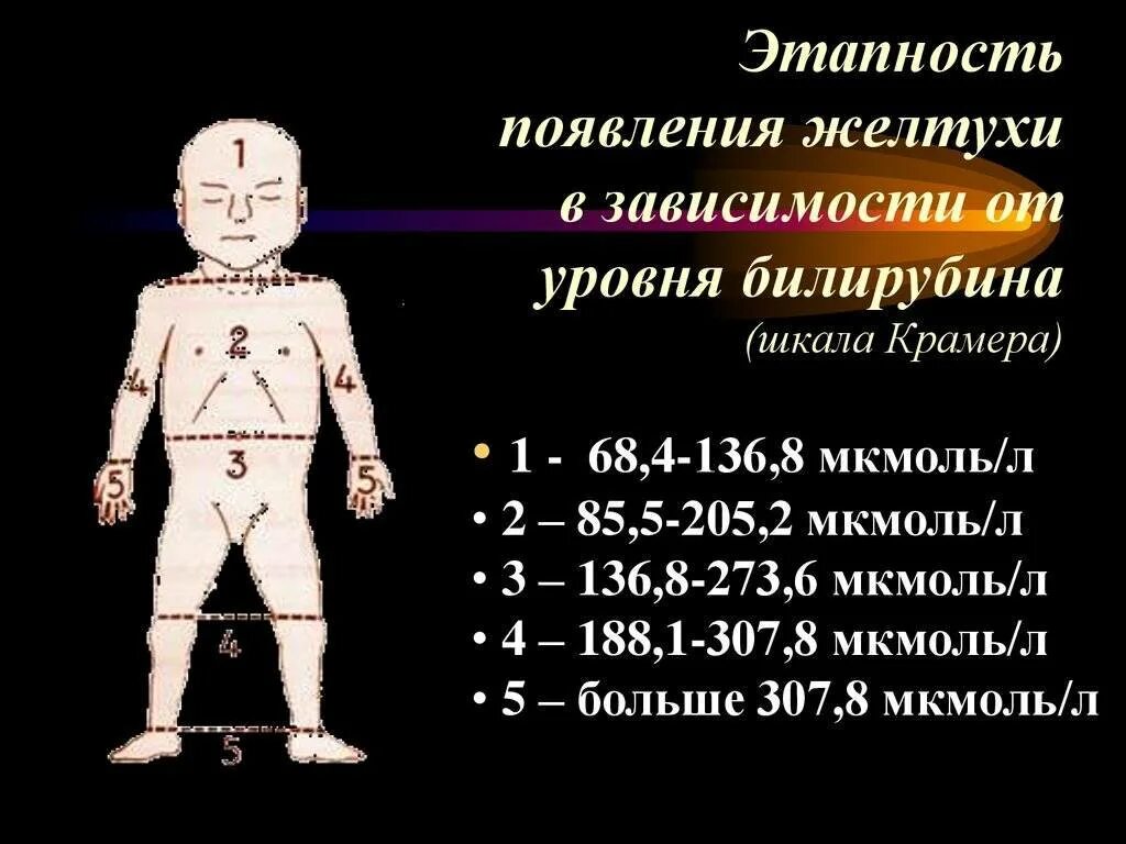 Показатели желтухи у новорожденных норма. Показатели физиологической желтушки у новорожденных. Желтуха новорожденных шкала Крамера. Степени желтухи у новорожденных по Крамеру. Билирубин при желтухе у новорожденных