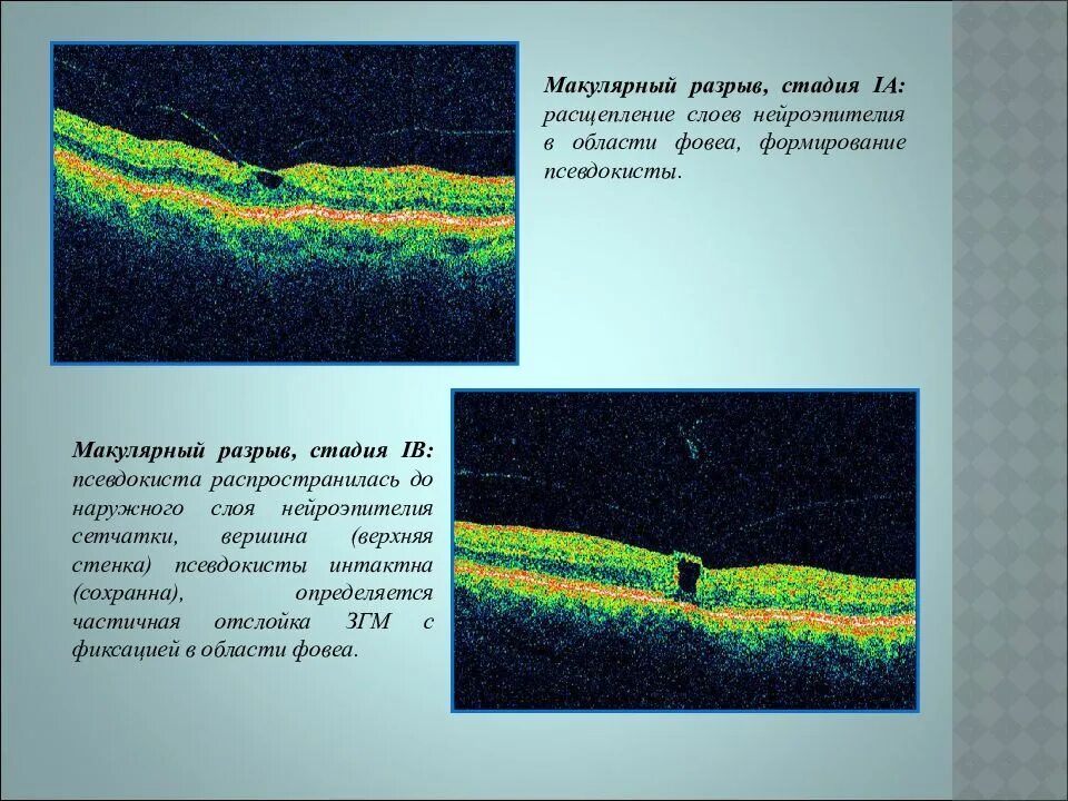 Макулярный разрыв после операции. Ламеллярный макулярный разрыв. Оптическая когерентная томография макулы. Макулярный разрыв окт. Сквозной макулярный разрыв.