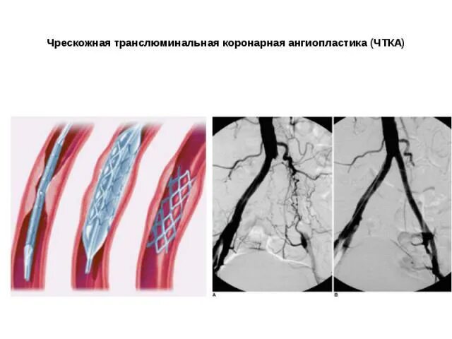 Баллонная коронарная ангиопластика. Эндовенозная ТРАНСЛЮМИНАЛЬНАЯ ангиопластика. Чрескожная ТРАНСЛЮМИНАЛЬНАЯ коронарная ангиопластика. ТРАНСЛЮМИНАЛЬНАЯ баллонная ангиопластика почечной артерии. ТРАНСЛЮМИНАЛЬНАЯ баллонная ангиопластика и стентирование.