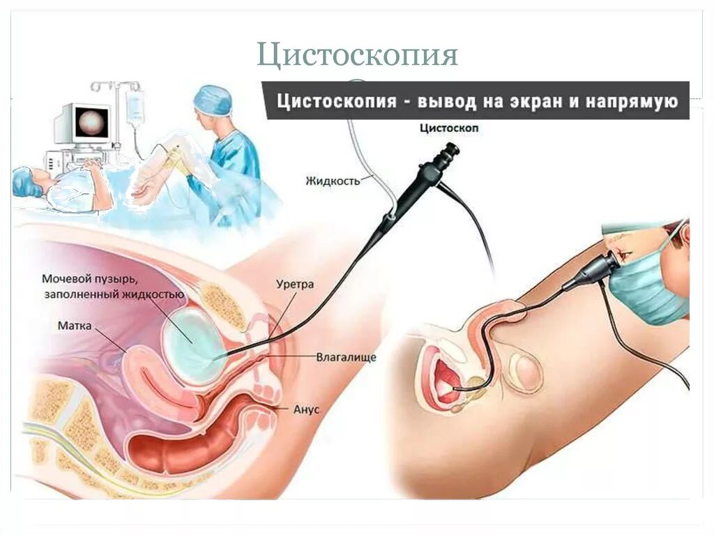 Цистоскопия мочевого пузыря у женщин как делают. Цистоскопия метод исследования. эндоскопическое исследование мочевого пузыря. холодная биопсия мочевого пузыря. цистоскопия методика проведения.