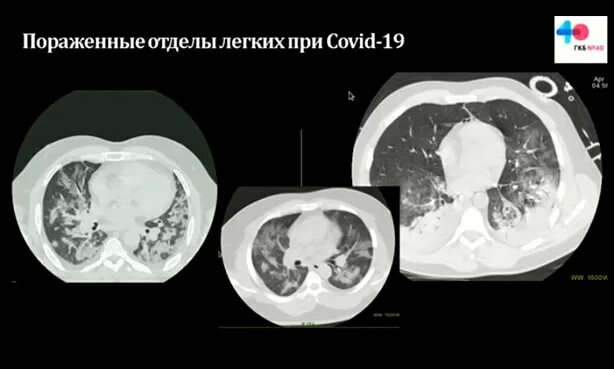 Фиброз кт. Фиброз на кт. перибронхиальный фиброз на кт. фиброз в легком на кт. легкие на кт при коронавирусе.