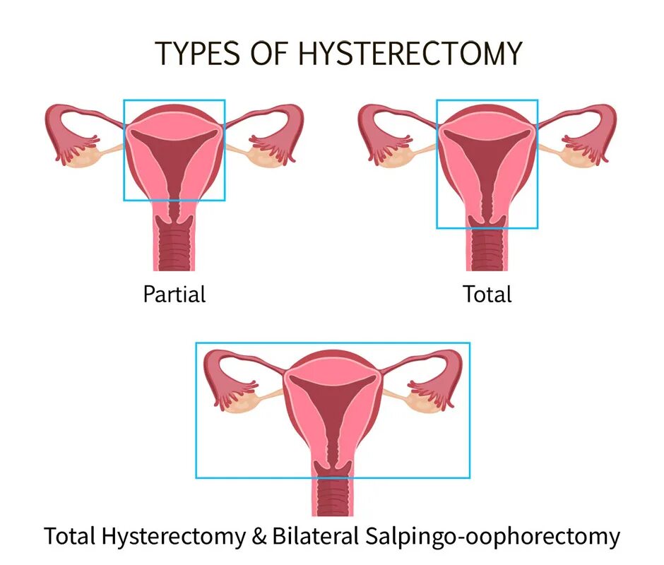 Гистерэктомия что это такое простыми. Экстирпация шейки матки. Супрацервикальная гистерэктомия. Тотальная гистерэктомия. Гистерэктомия с шейкой матки.