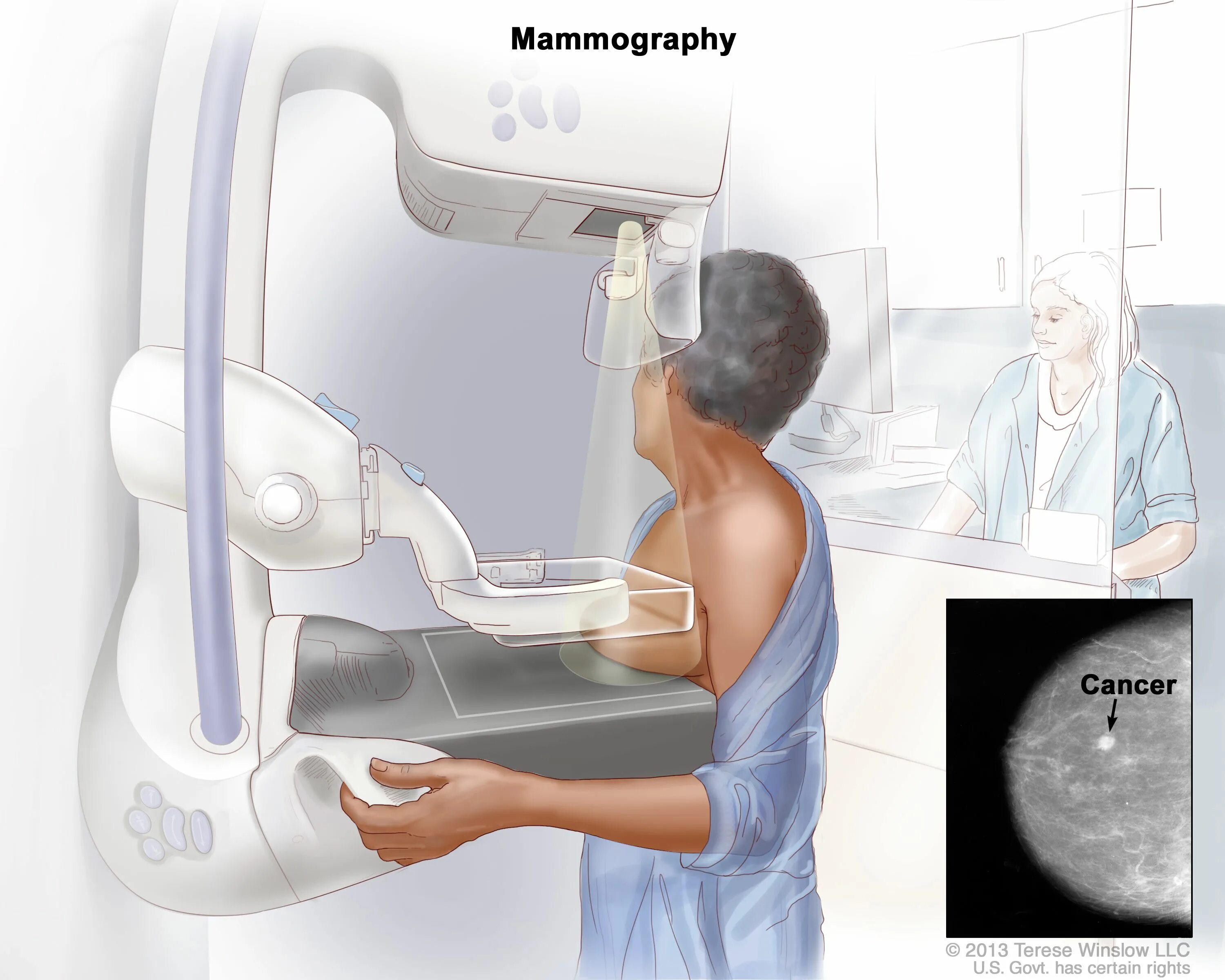 Breast Cancer Breakthrough? 3D Mammograms Offer Sharper Results