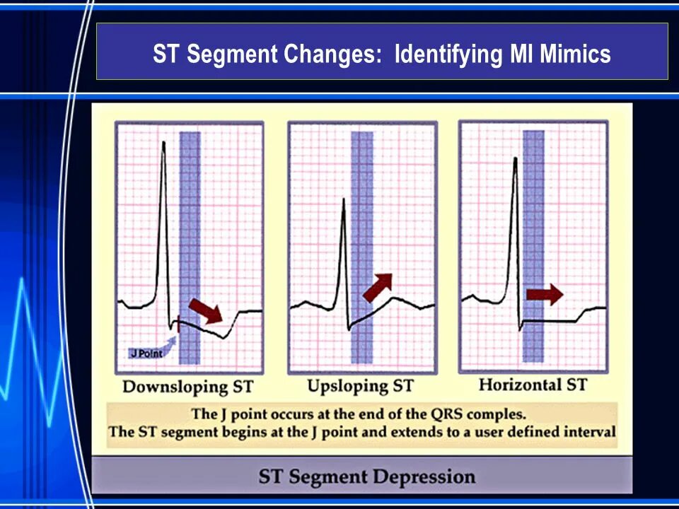 Депрессия сегмента st. St segment depression. ЭКГ 1997 Frank g Yanowitz m d. St depression induced by exercise relative to rest. Сегмент St Продолжительность соответствие.