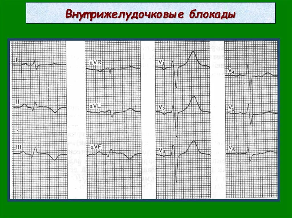 Неспецифические изменения нижней стенки. Внутрижелудочковые блокады на ЭКГ. Внутрижелудочковая блокада. Блокада левой ножки пучка Гиса.. Признаки внутрижелудочковой блокады на ЭКГ. Очаговая внутрижелудочковая блокада на ЭКГ.