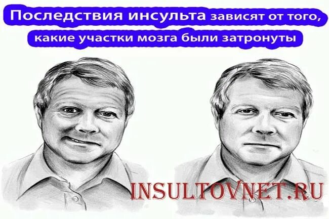 Какая сторона инсульта опаснее правая или левая. Последствия инсульта. Осложнения инсульта. Карикатуры про инсульт. Первые признаки инсульта.