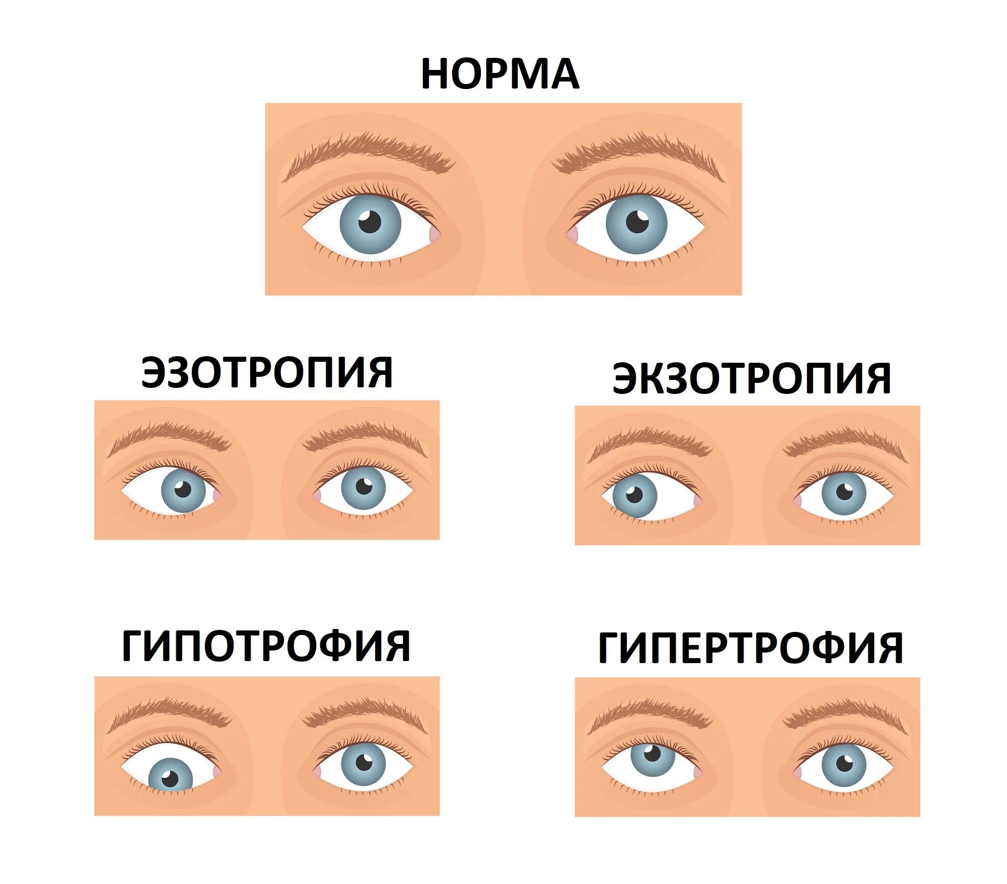 Почему бывшие сходятся. Типы косоглазия у детей. Содружественное косоглазие. Сходящееся косоглазие причины. Косоглазие у детей причины.