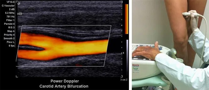Дуплекс нижних конечностей. Ультразвуковая допплерография артерий нижних конечностей. Ультразвуковое дуплексное ангиосканирование. Допплеровское сканирование вен нижних конечностей. Ультразвуковое компрессионное дуплексное ангиосканирование.