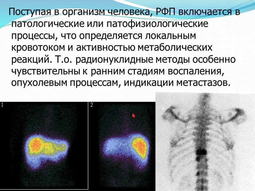 Рфп при пэт кт. РФП В медицине в онкологии это. РФП это лучевая диагностика. РФП расшифровка.