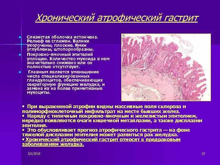 Желудок хронический гастрит гистология. Атрофический гастрит патанат. Хронический атрофический гастрит патанатомия микро. Хронический атонический гастрит. Эпителиальное образование желудка что это