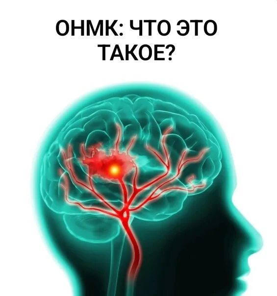 Инсульт нервной системы. Нарушение кровоснабжения мозга. Сосудистые патологии ЦНС. ОНМК.