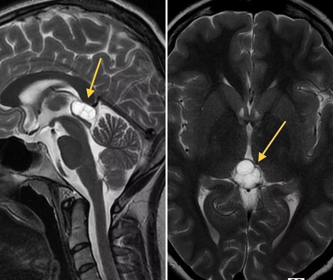 Киста шишковидной железы в головном мозге кт.