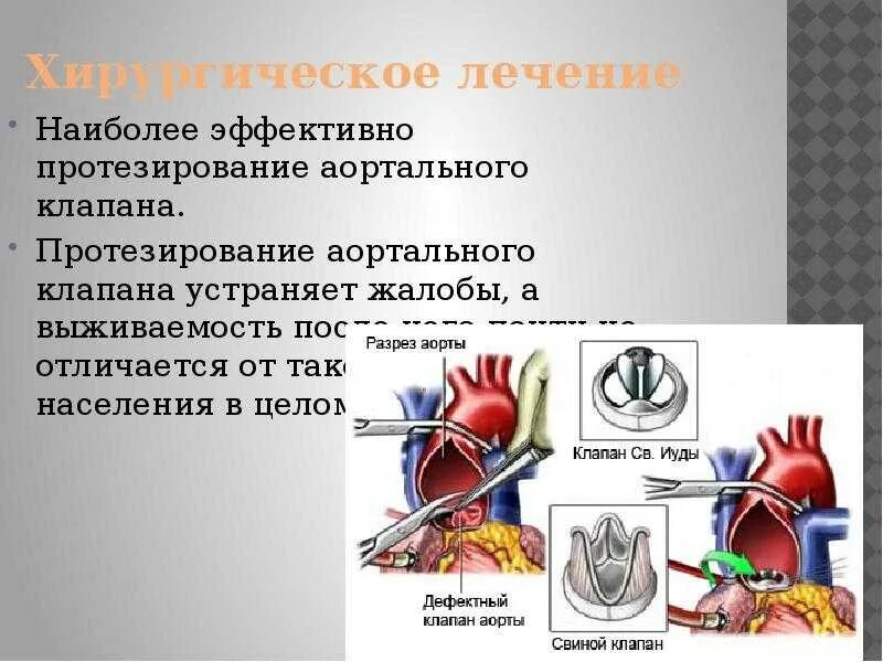 После протезирования аортального клапана. После протезирования аортального клапана
