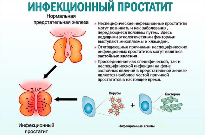 Бактериальная простата. Хронический бактериальный простатит. простата у мужчин симптомы.