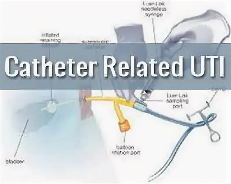 Катетер бартолиновой железы. Catheter associated UTI. Word катетер бартолиновой железы.