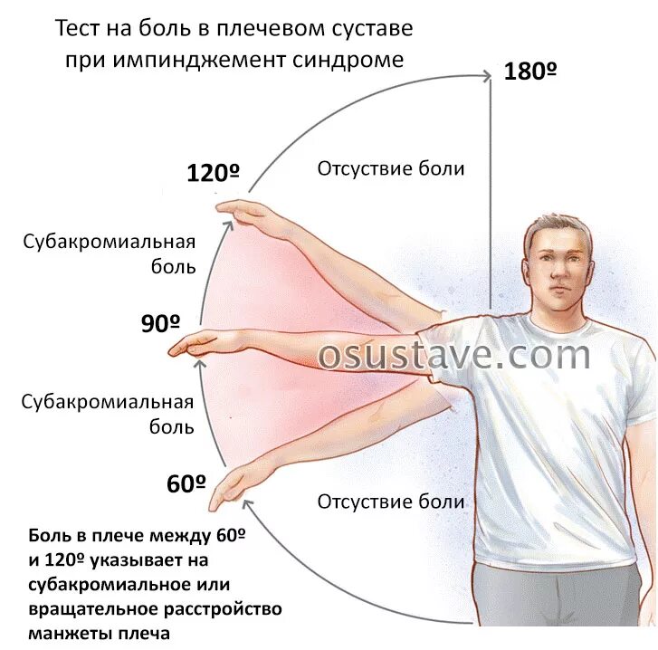 Почему болит сустав плеча. Субакромиальный синдром плечевого сустава ЛФК. ЛФК при импиджмент синдром правого плечевого сустава. Субакромиальный болевой синдром. Лечебная физкультура при импинджмент синдроме плечевого сустава.