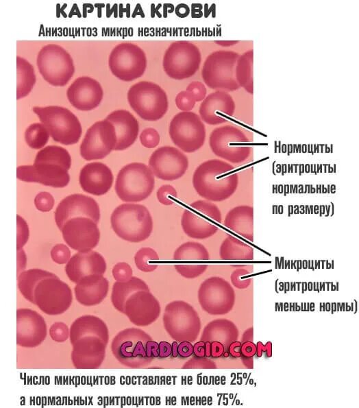 Показатели при микроцитарной анемии. Макроцитарные нормохромные анемия. Железодефицитная анемия картина крови. Анизоцитоз микро незначительный эритроцитов.