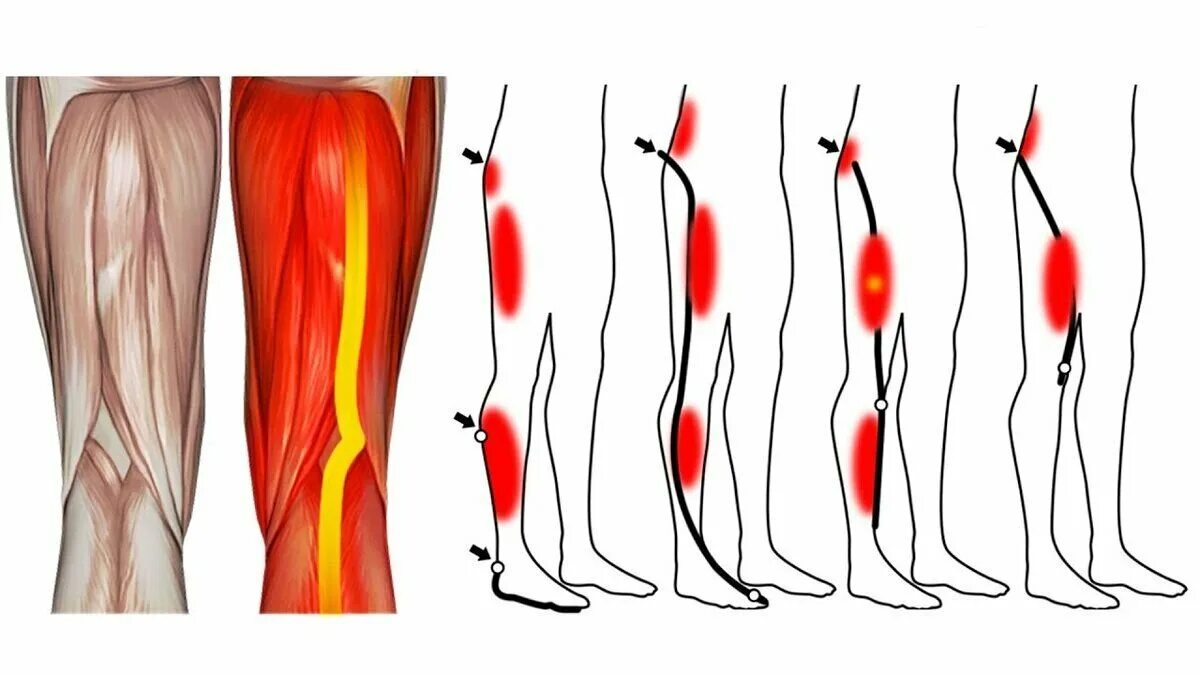 Почему сильно болят икры. Боли от бедра до колена.