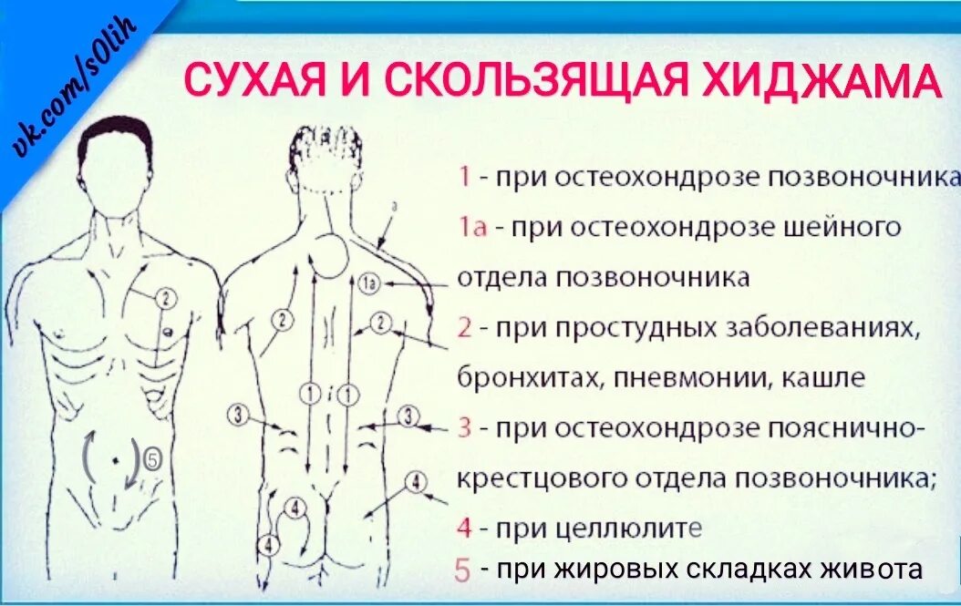 На сколько ставят банки на спину взрослым. Схема постановки вакуумных банок. Точки для постановки банок. Точки хиджамы схема. Точки для постановки банок на спину.