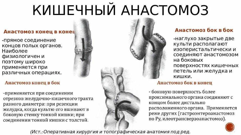 Перетрубация что это такое. Классификация кишечных анастомозов. Резекция тонкой кишки анастомозы техника. Резекция тонкой кишки. Виды межкишечных анастомозов.. Анастомоз кишечника классификация.