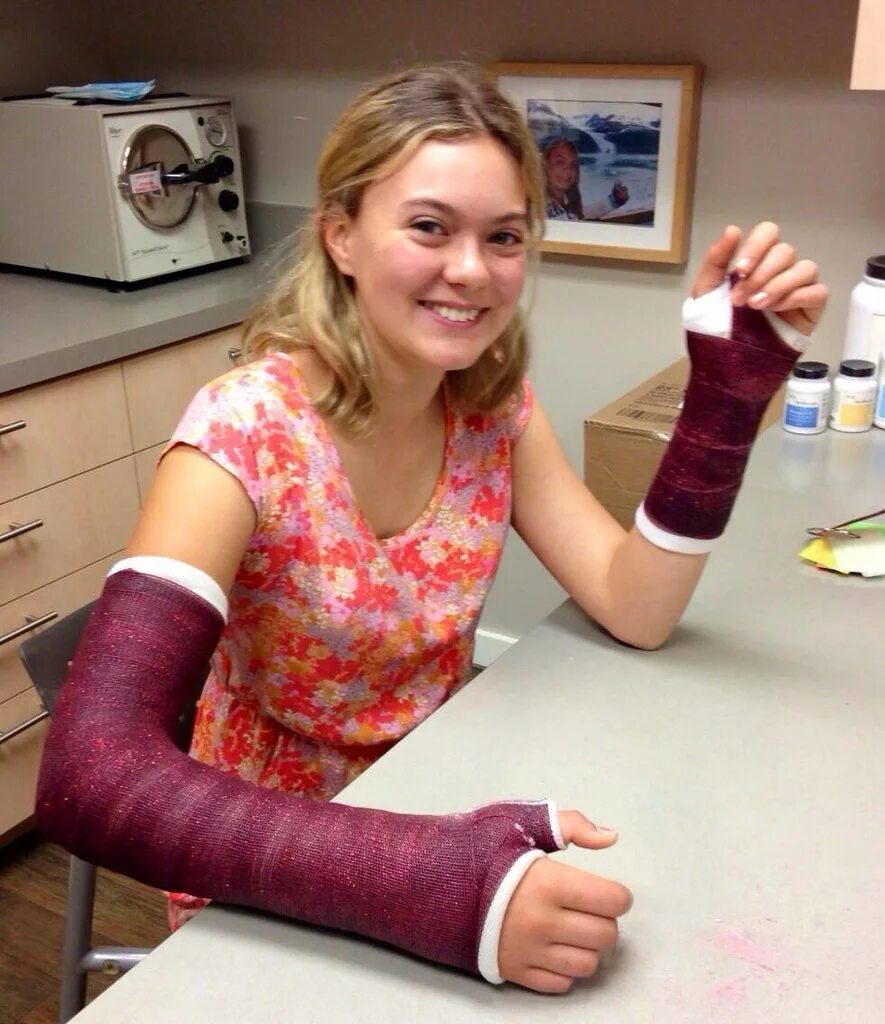 Arm casting. Arm cast. розовый гипс. девушка gips. double long arm cast.