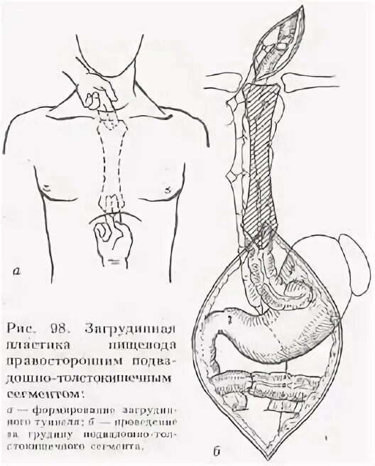 Операции на пищеводе. Пластика пищевода по ру-Герцену-Юдину 5 этапов. Операции на пищеводе пластика пищевода. Пластика пищевода показания. Загрудинная пластика пищевода по н.и. Еремееву.