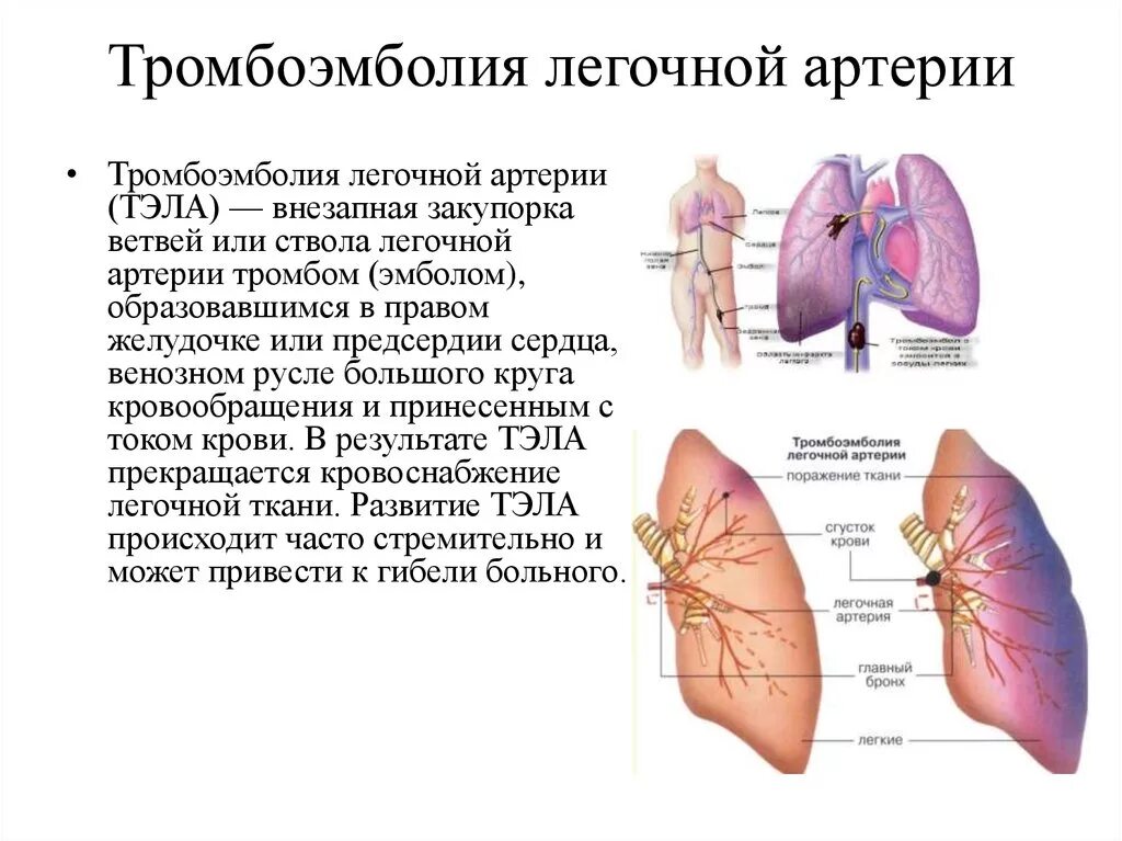 Тромбоэмболия легочной артерии причины развития. Тромбоэмболия крупных ветвей легочной артерии. Тромбоз лёгочной артерии симптомы. Локализация тромбов при тромбоэмболии легочной артерии. Тромболегочная эмболия