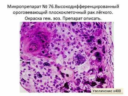 Плоскоклеточный рак легкого