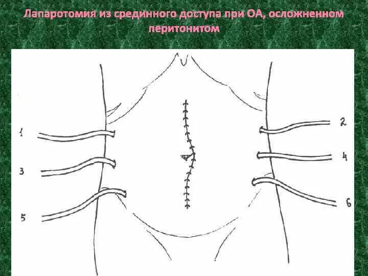 Какое лапаротомия. Верхнесрединная лапаротомия показания. Нижнесрединная лапаротомия при аппендэктомии. Верхняя срединная лапаротомия шов. Срединная поперечная лапаротомия.