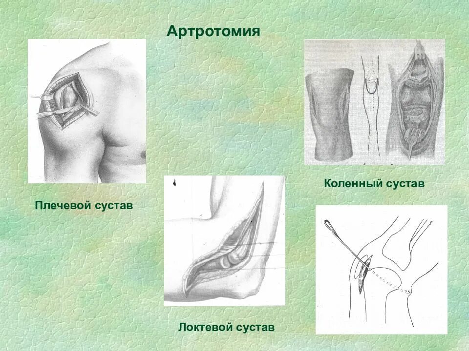 Артротомия плечевого сустава. Линии артротомии локтевого сустава. Артротомия по Лангенбергу. Артротомия локтевого сустава по Кохеру. Артротомия плечевого, локтевого, коленного суставов.