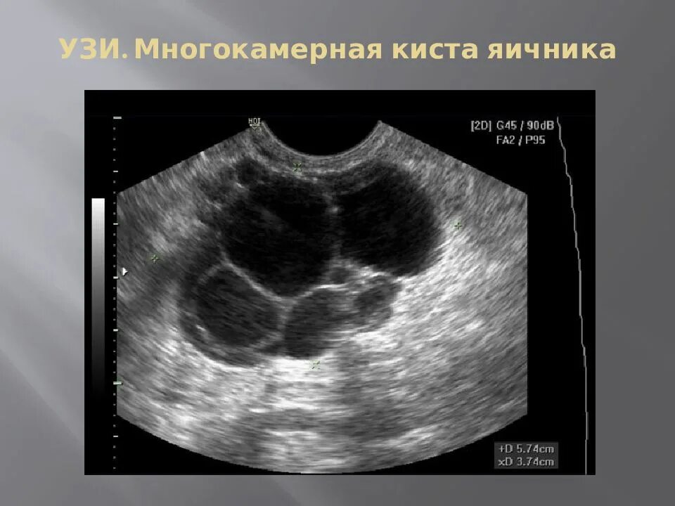 Можно ли спутать кисту. Многокамерная киста яичника на УЗИ. Серозная кистома яичника.