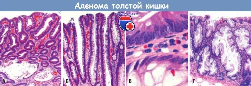 Тубулярная аденома толстой. Зубчатая аденома толстой кишки гистология. Ворсинчатая аденома толстой кишки микропрепарат. Тубулярная ворсинчатая аденома. Тубулярная аденома толстой кишки гистология.