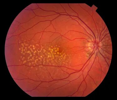 Age related macular degeneration