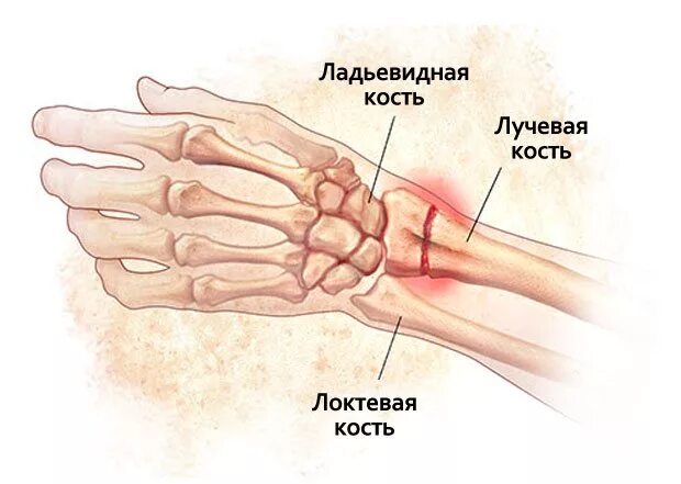Перелом лучезапястного сустава лечение. Упражнения для реабилитации кисти после перелома лучевой кости. лфк после перелома ладьевидной кости кисти. лучевой сустав кисти. лечебная физкультура при переломе лучевой кости на запястье.