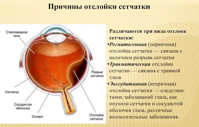 Сетчатка глаза строение отслоение. Регматогенная отслойка сетчатки глаза. Отслойка сетчатки схема. Первичная отслойка сетчатки этиология.