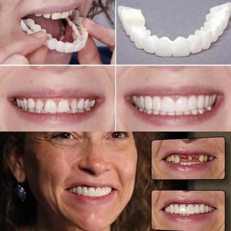 What are clip on veneers? News Dentagama Veneers teeth, Perfect smile teeth, Sna