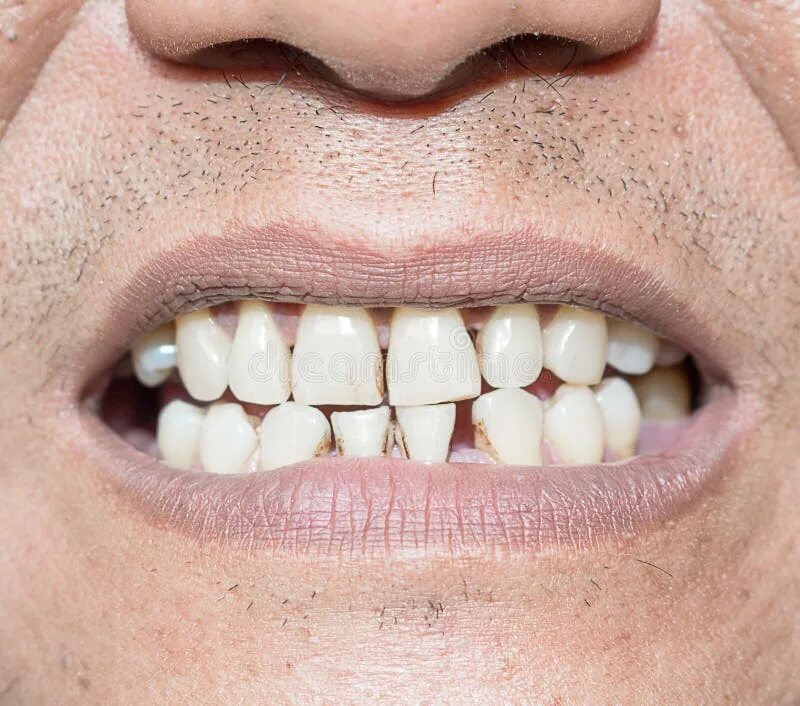 New Press On Veneers by Brighter Image Lab are Changing Lives - YouTube