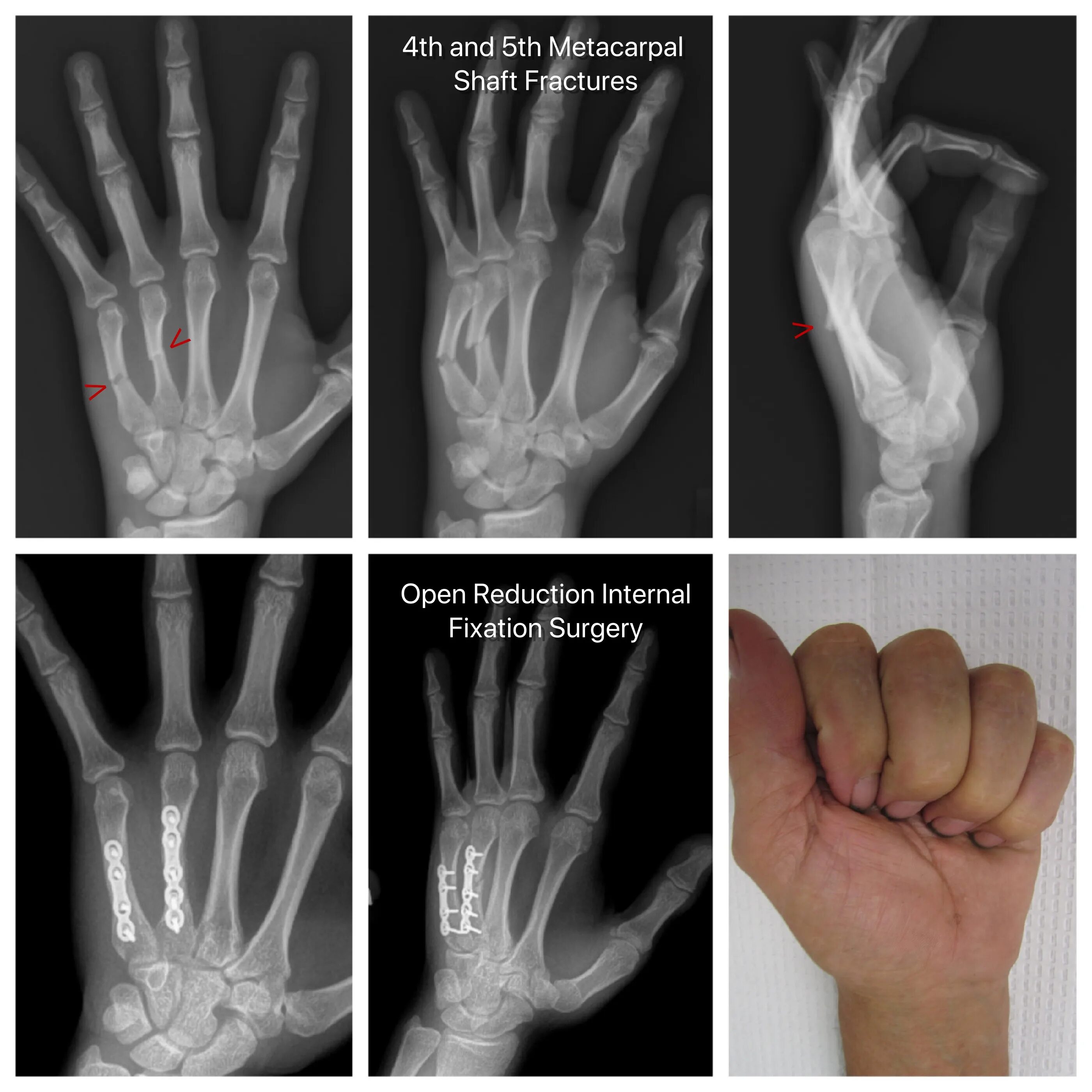 Трещина 5 букв. Metacarpal. Fracture secind metacarpal Bone.