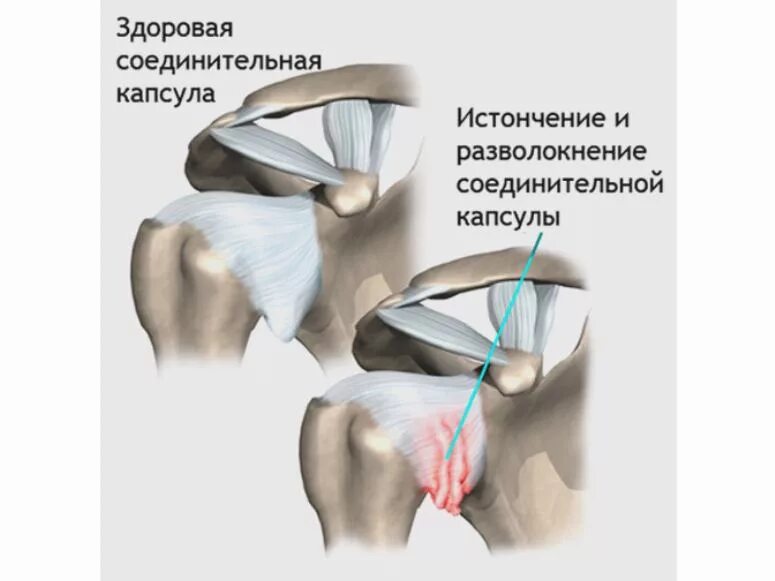 Капсулит симптомы и лечение. Адгезивный капсулит плечевого сустава. Адгезивный капсулит плечевого сустава блокада. Фиброзирующий капсулит. Плечевой капсулит симптомы.