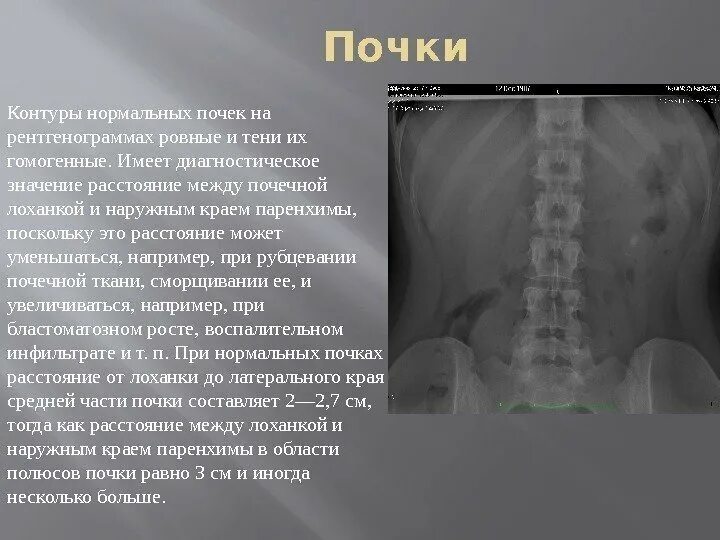 Неровный контур почек. Неровный контур почек. Эхоструктура неоднородная узи почек. Хронический пиелонефрит узи. Кт почек норма.