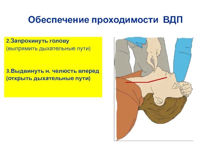 Обеспечение дыхательных путей алгоритм. Обеспечение проходимости вдп. обеспечить проходимость дыхательных путей. обеспечение проходимости верхних дыхательных путей. нарушение проходимости верхних дыхательных путей.
