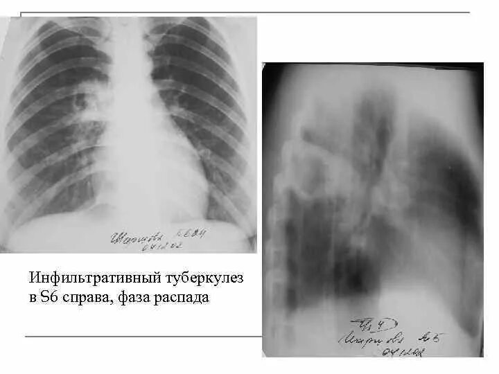Инфильтративный легкого в фазе распада. Инфильтративный туберкулез s6. Инфильтративный туберкулез в фазе распада s6. Инфильтративный туберкулез s6 справа. Инфильтративный туберкулез легких в фазе распада.