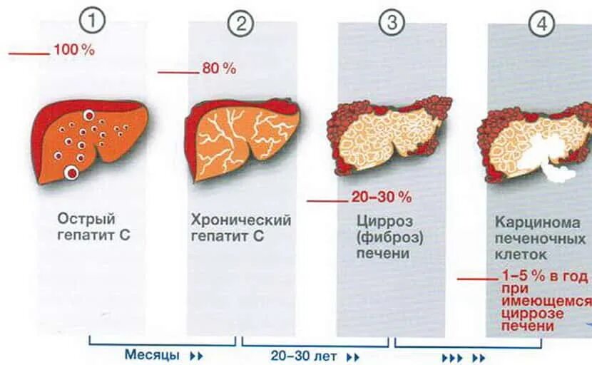 Можно прожить с гепатитом с. Хронический гепатит б цирроз печени. Этапы поражения печени при гепатите с. Цирроз печени стадии гепатит с.