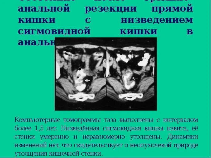 Сколько длится операция по удалению прямой кишки. Сигмовидная кишка кт анатомия. брюшно анальная резекция с низведением сигмовидной кишки. резекция с низведением сигмовидной кишки. брюшно-анальной резекции прямой кишки с низведением сигмовидной,.