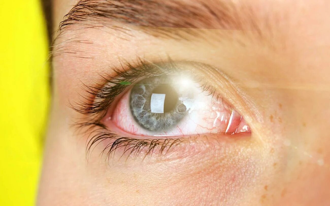 синдром сухого глаза у ребенка