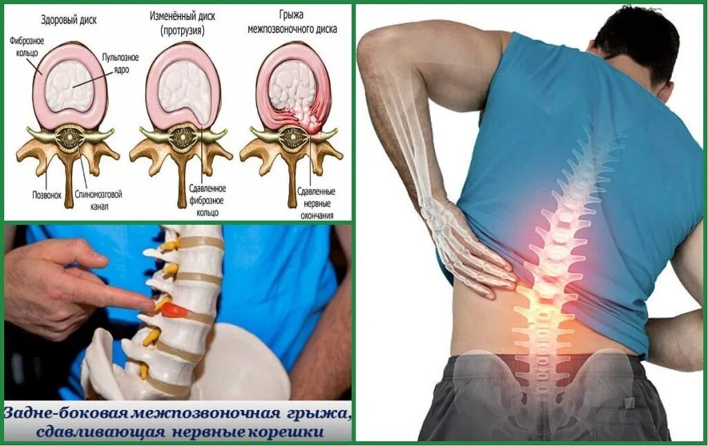 Грыжа позвоночника. Грыжа позвонка. Позвоночная грыжа на спине.