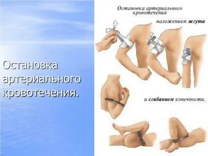 Порядок остановки артериального кровотечения